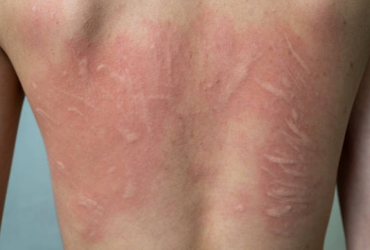 두드러기의 일종인 피부묘기증
