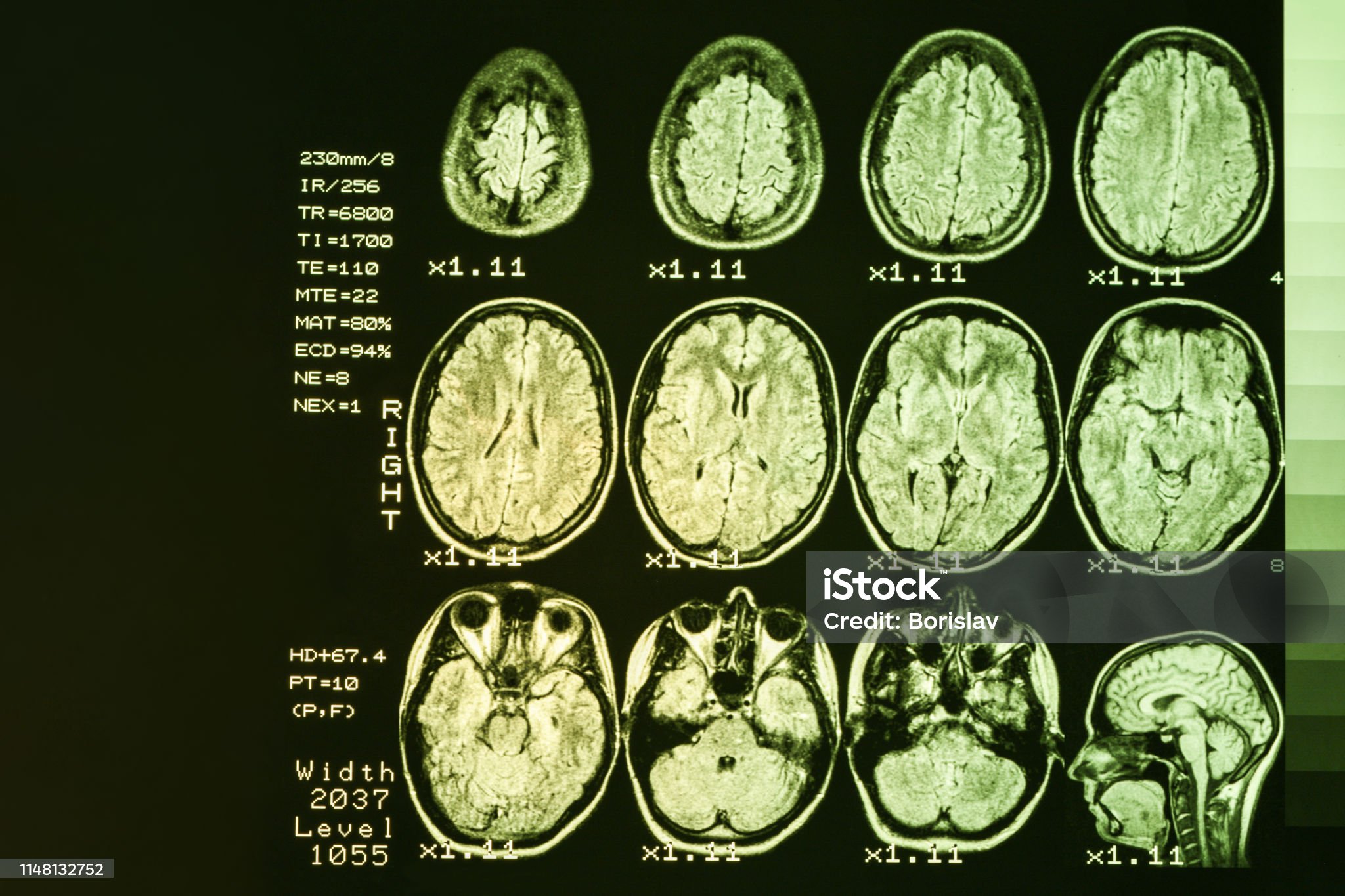 헌팅턴병과 치매