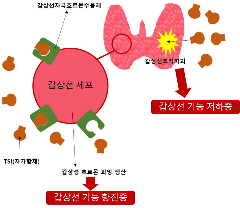 갑상선 항진증 저하증 설명