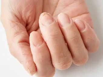 손톱이 갈라지는 이유 원인 증상 대처법_25