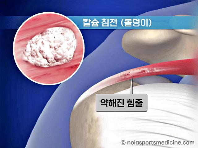 석회성건염에 좋은음식,석회화건염 좋은음식,팁줌