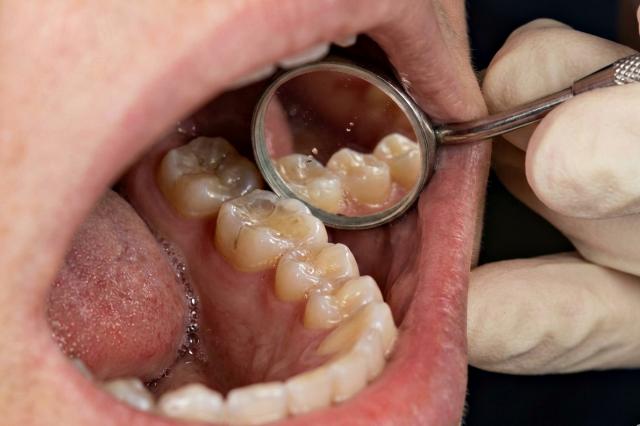 위산 역류 증상 치아 변색