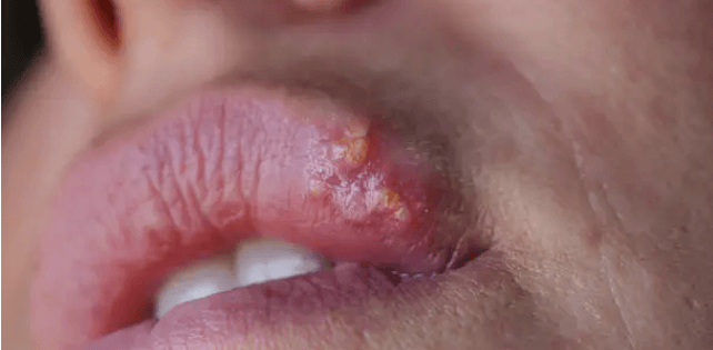 입술포진은 왜 반복될까? 입술포진 증상과 원인, 입술포진 빨리 낫는 법!