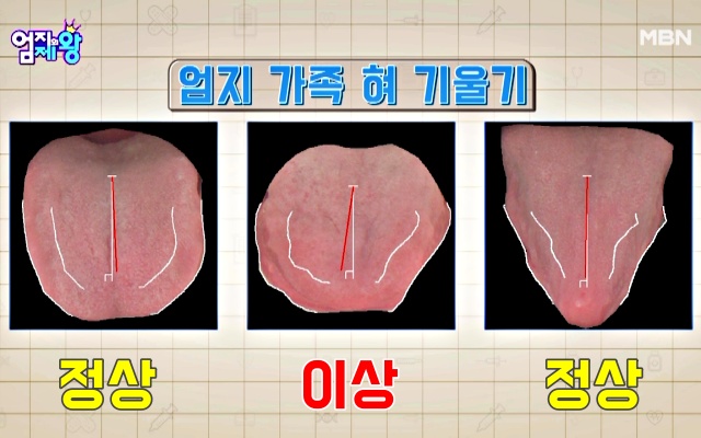 혀로 보는 뇌졸중 의심 초기증상 전조증상, 혀 기울기, 혀 건강체크, 혀 건강상태, 건강 팁줌 매일꿀정보