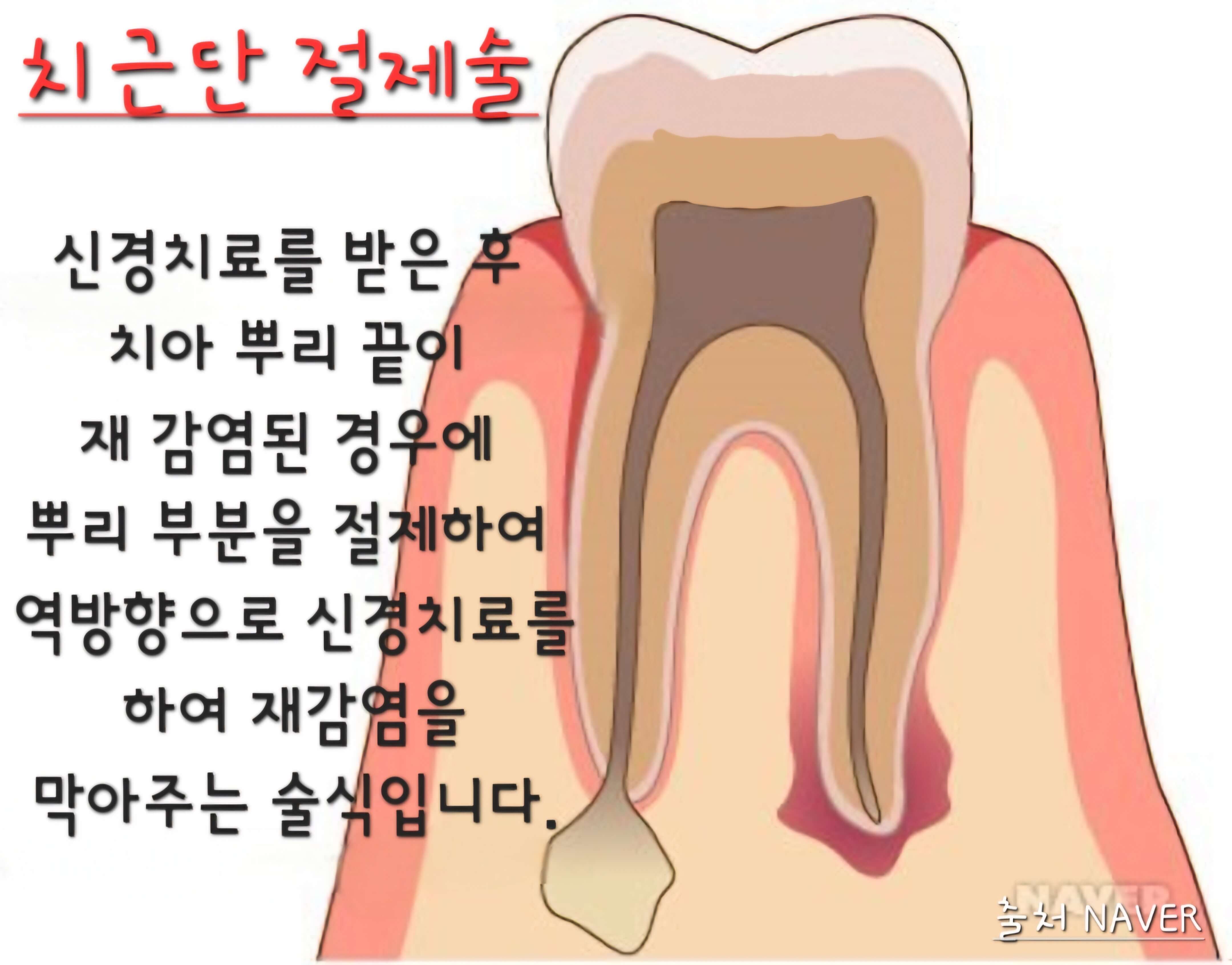 신경치료후 재감염된치아