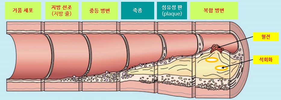 죽종 형성과 그 이후의 경과 출처 BMJ