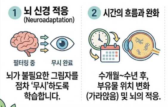비문증 치료방법