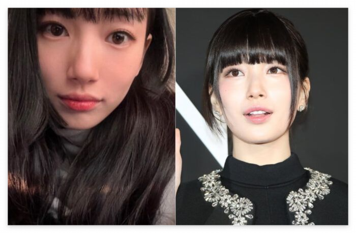 수지 결막모반 원인, 해결법