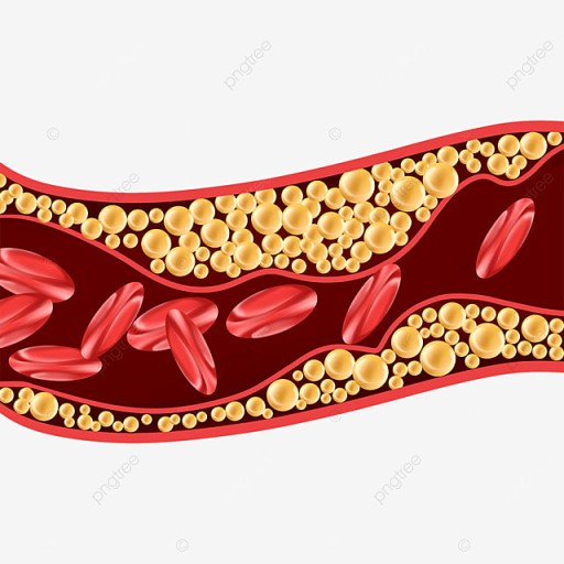 고지혈증(증상, 원인, 치료 및 예방법)