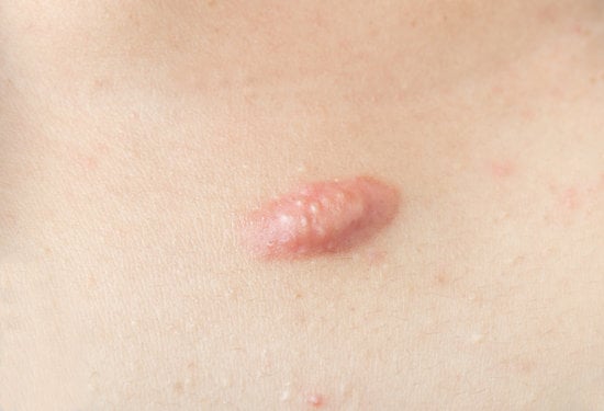 켈로이드 (Keloid Scars): 원인과 효과적인 치료 방법