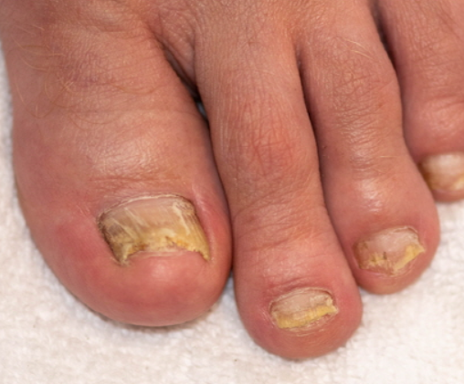 발톱무좀 없애는 방법 4