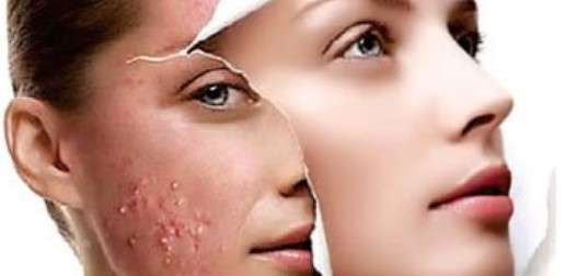 [Q&amp;A] 사춘기여드름, 성인여드름, 생식기여드름 원인 및 치료방법, 예방법, 좋은 음식