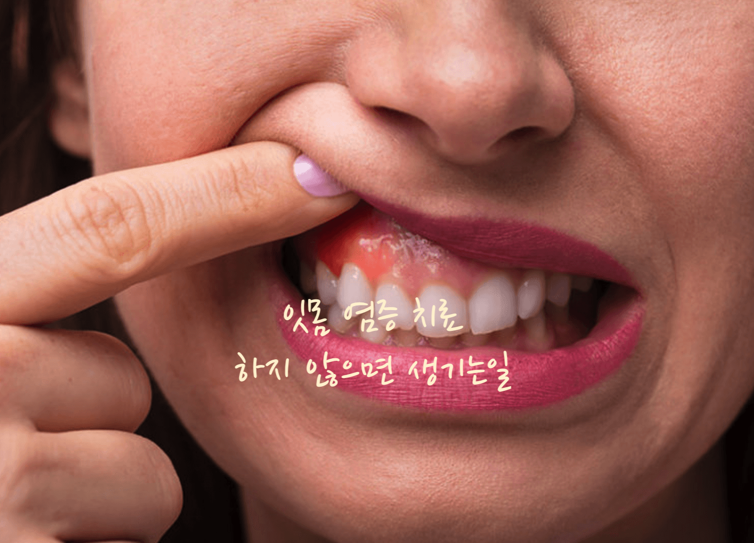 잇몸 염증