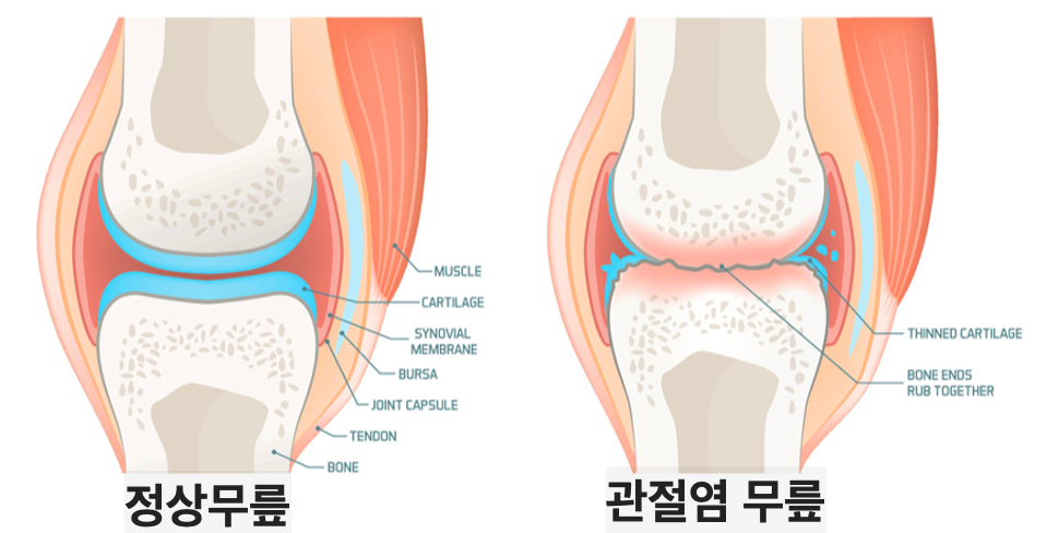 무릎관절염-자가지방기질혈관분획주사