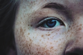 기미 없애는 방법