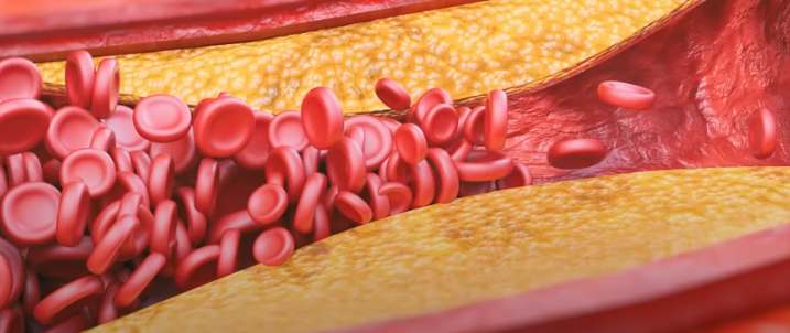 혈관 막힘 증상 예시