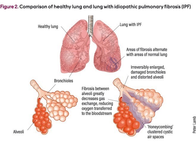 특발성 폐섬유증