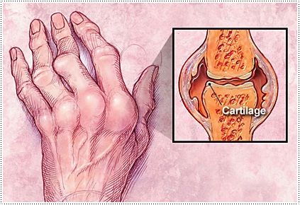 류마티스 관절염 초기증상