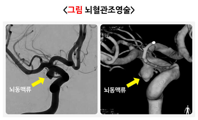 뇌동맥류 총정리 원인 증상 치료법 예방