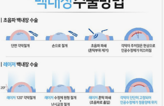 백내장 원인과 치료방법