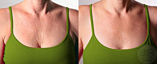 쇄골 밑 가슴 주름 없애는법,팁줌