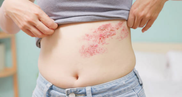 대상포진 증상&amp;#44; 전염&amp;#44; 치료방법 총정리 (2024ver)