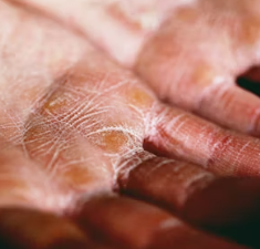 건조증 증상 피부 안구 코 구강 원인 치료법