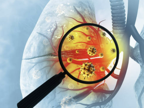 마이코플라스마폐렴증상