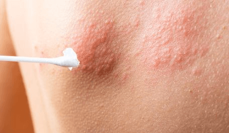 한랭 두드러기 질환으로 피부가 붉게 변한 사진