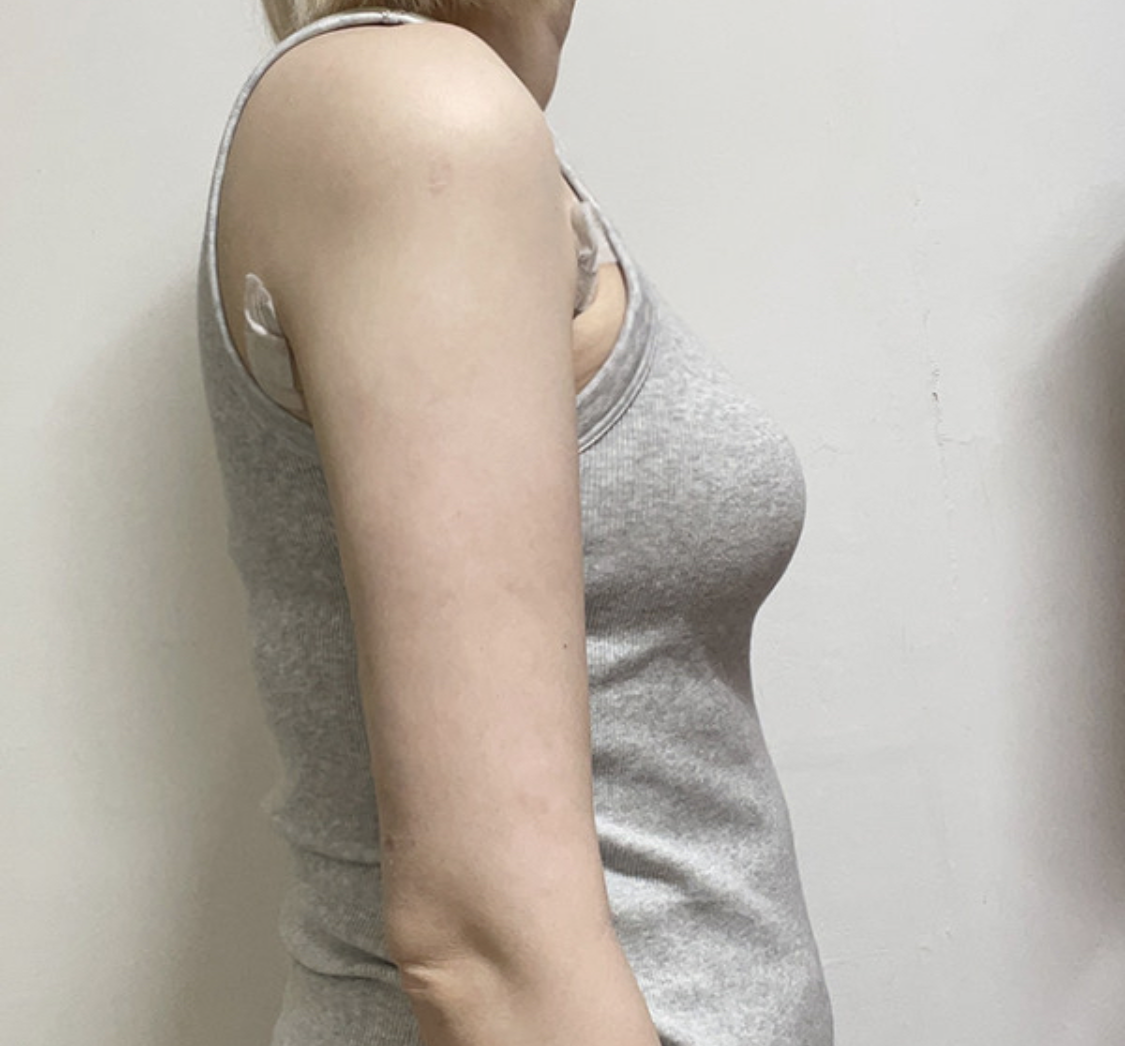 4주차 경과 사진.