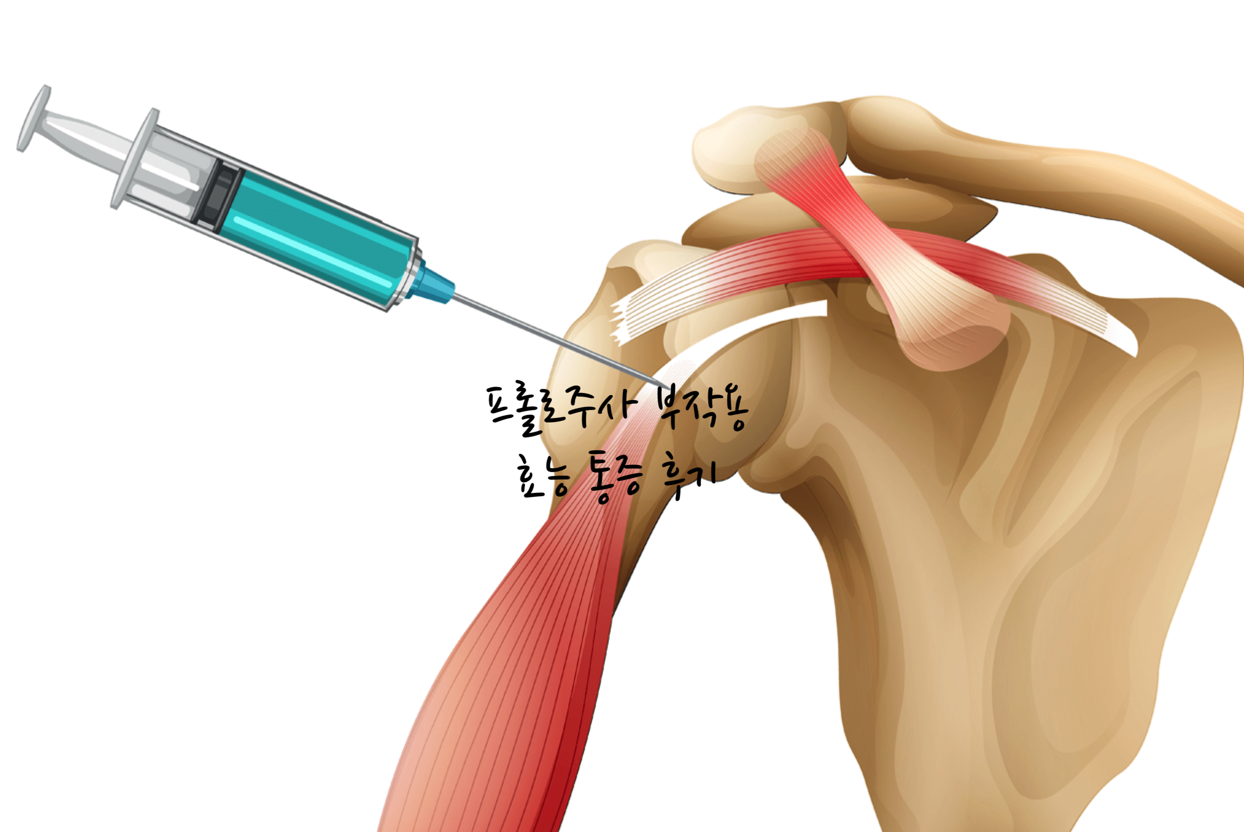 프롤로주사 후기