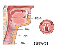 후두염 증상