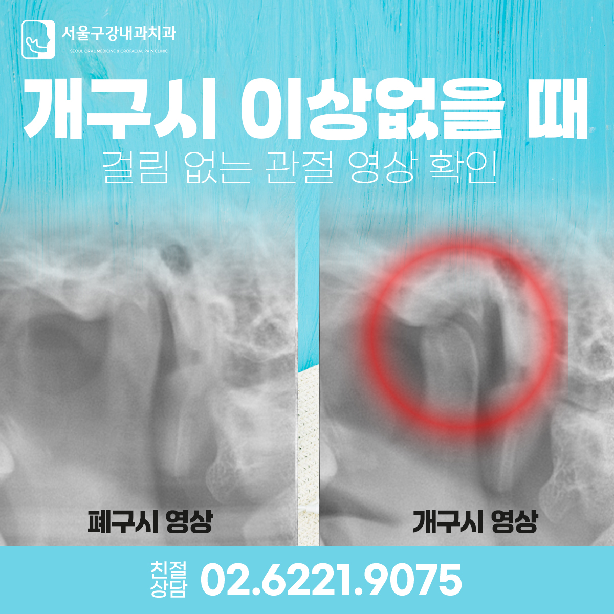 관절이 모양은 정상처럼 보여도 과두가 디스크에 걸리는 턱관절 CT 비교 이미지, 개구제한 원인 설명