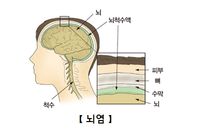 일본뇌염