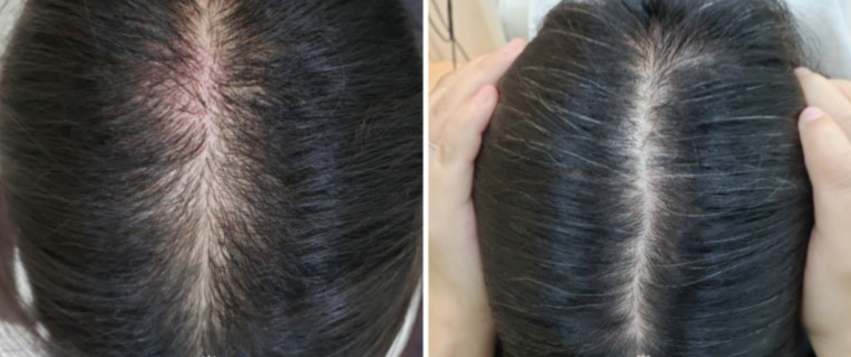 모발이식 3000모 비용 4000모 비용 부작용 과정