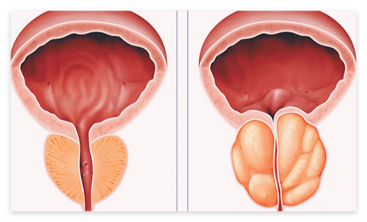 전립선에-좋은-음식