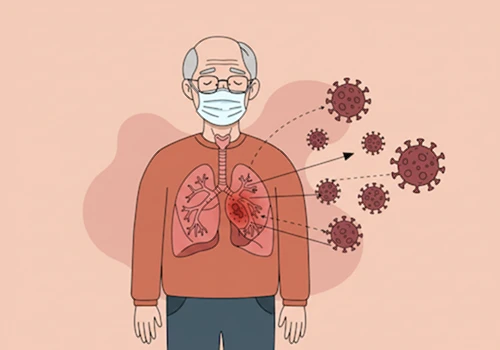 정보 전달 일러스트 스타일로 그린&amp;#44; 약해진 면역력의 60세 이상 어르신 호흡기에 RSV 바이러스가 침투하여 위험해지는 모습.