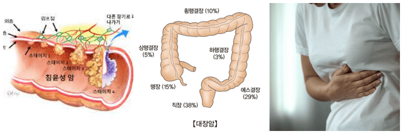 대장암, 대장암 부위, 복통 사진