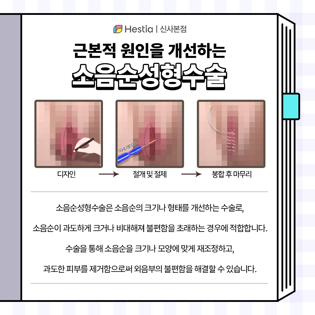 근본적인 원인 해결 : 소음순성형수술