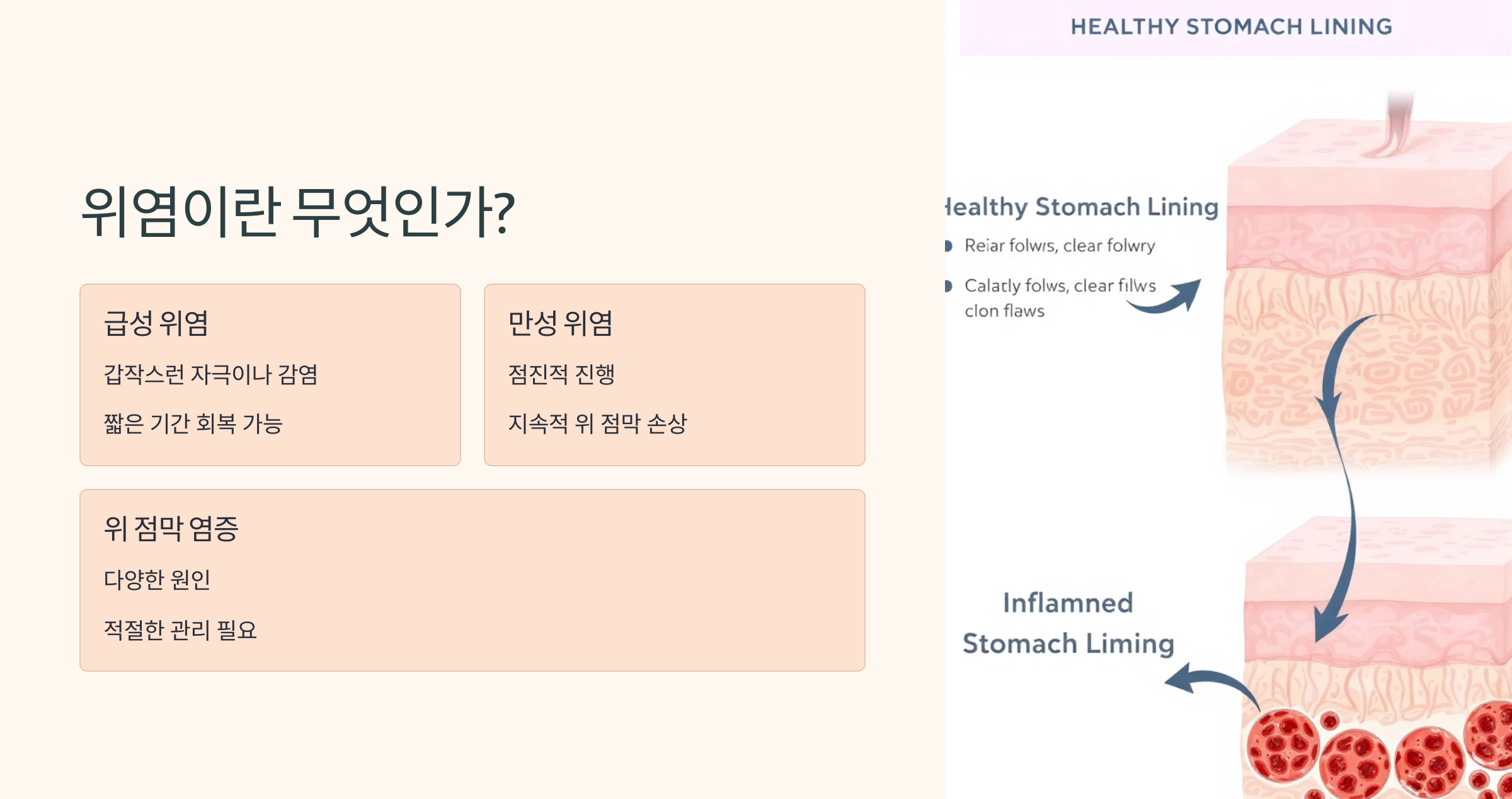위염이 무엇인지에 대해서 간략하게 설명한 이미지