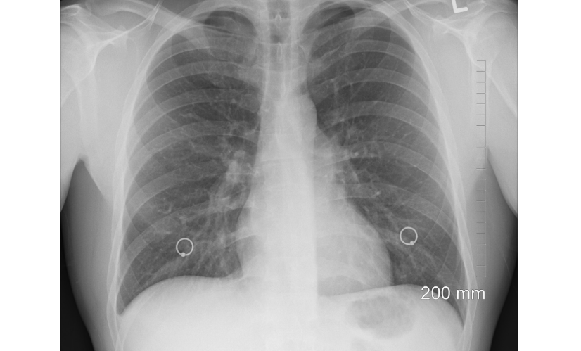 늑간신경통 완벽 가이드: 원인부터 증상, 치료와 관리법까지 한눈에!