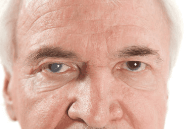 백내장 수술비용