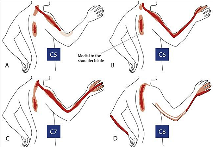목 디스크의 위치에 따른 증상 차이