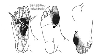 단무지굴근의 통증유발점과 연관통 부위를 나타낸 그림