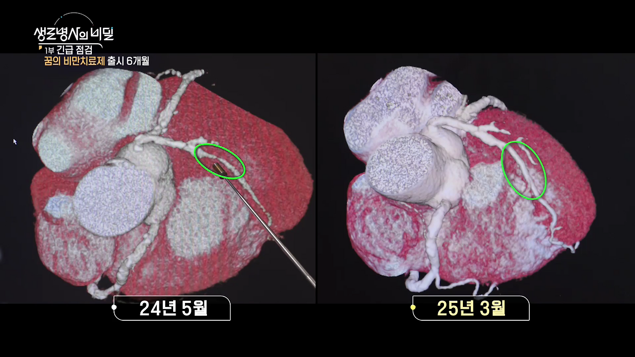 생로병사의 비밀 비만 탈출
