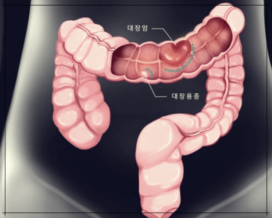 암 증상 10가지에 대한 이해