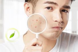 비립종 없애는 방법