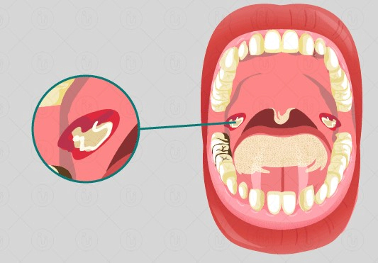 편도결석 자연치유 방법