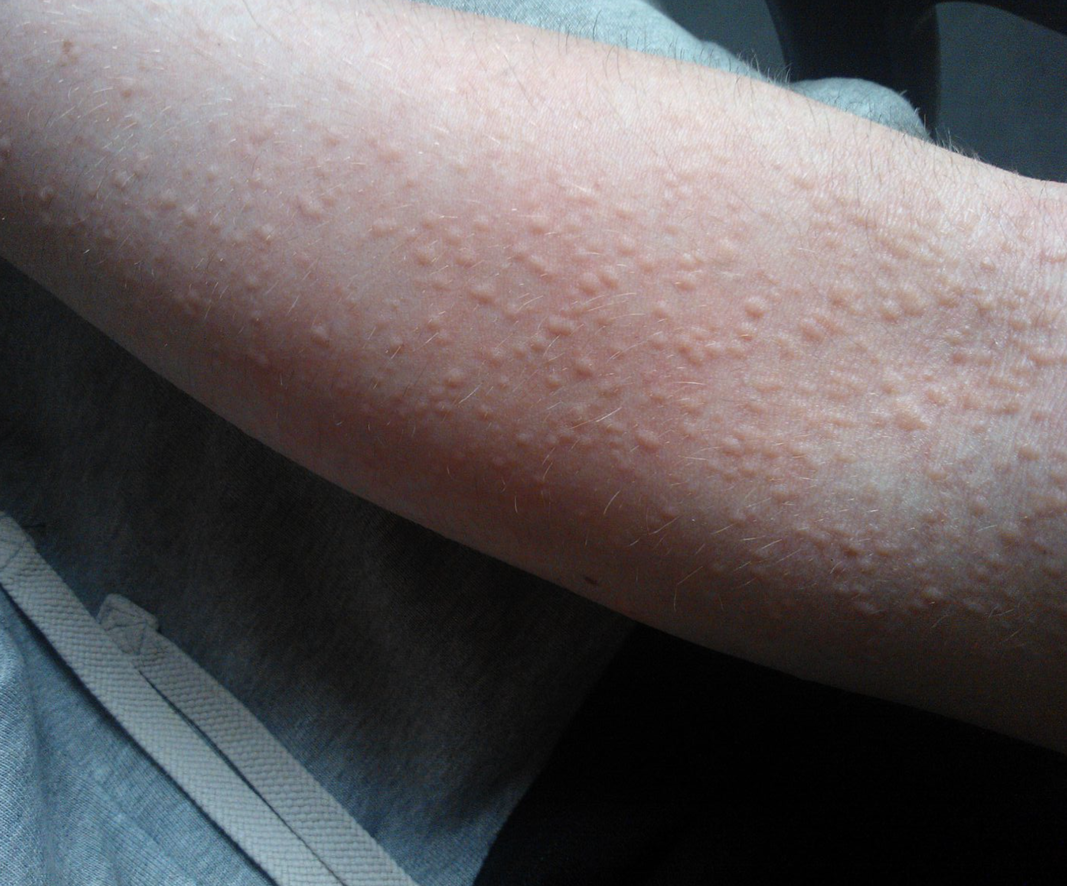 팔-좁쌀-알레르기