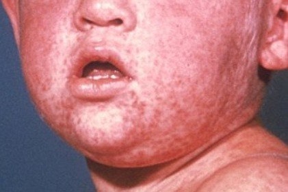 풍진에 걸린 아이의 모습